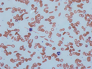Normal red blood cells and sickle cells.