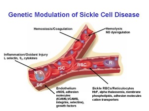 Study shows ways to limit stroke risk in young Sickle Cell patients